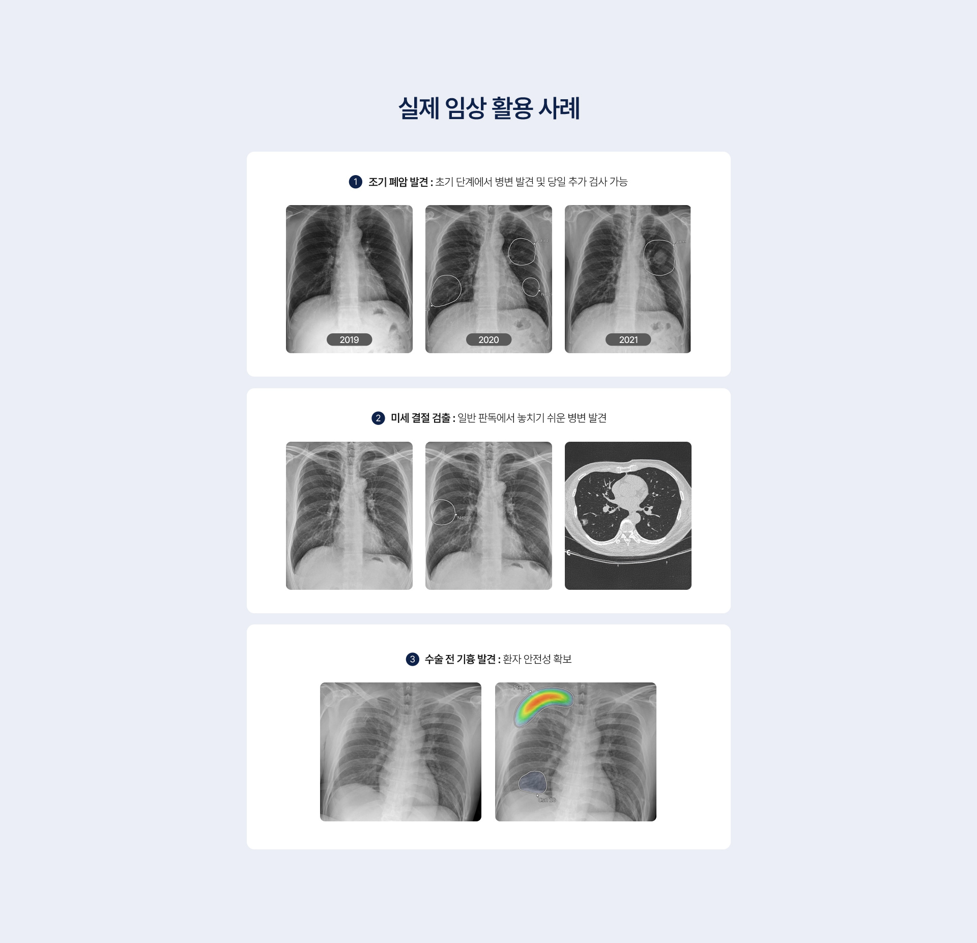 제노레이 흉부 X-ray